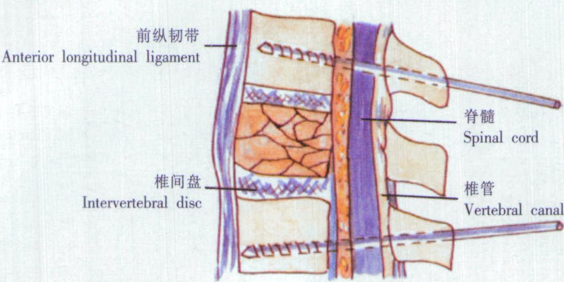 脊柱骨折、脱位切开复位Dick系统内固定术